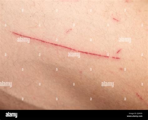 Laceration Wound Hi Res Stock Photography And Images Alamy