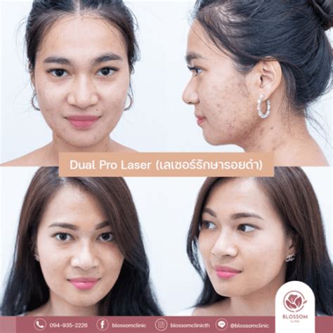 Dual Pro - รักษาสิว ปรับรูปหน้า โดยแพทย์ผิวหนัง