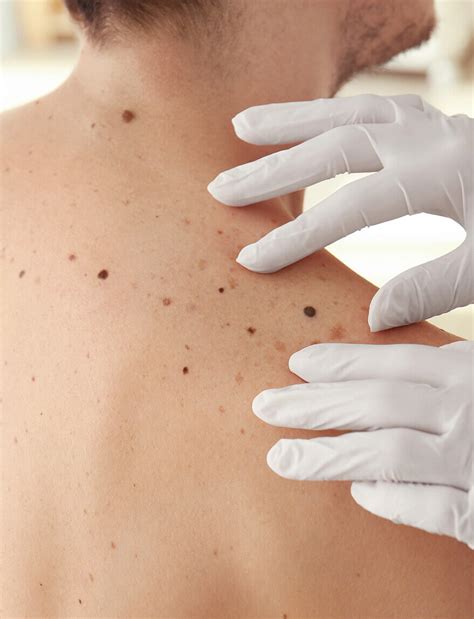 Wart And Verruca Removal Surrey Laser Treatment Epsom Skin Clinic