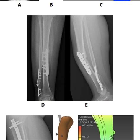 A C After Locking Plate Fixation A Immediate Postoperative X Ray