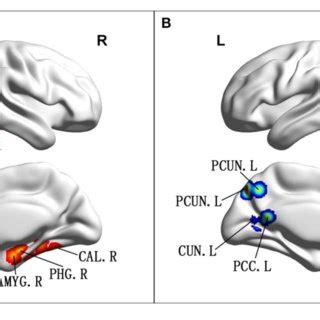 A Brain Regions Showing Increased ALFF FALFF In Patients With AMCI