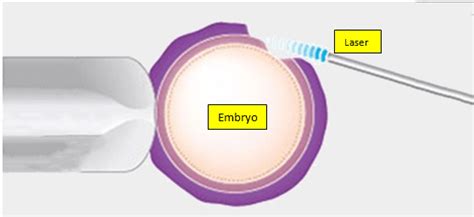 Laser Assisted Hatching Janani Fertility And Gyne Care