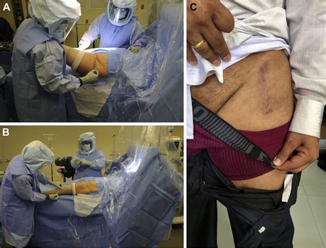 Total Hip Arthroplasty Through The Direct Anterior Approach Using A Bikini Incision Can Be