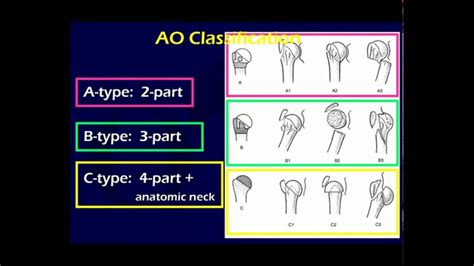 Proximal humerus fracture ao 463327-Proximal humerus fracture ao ...