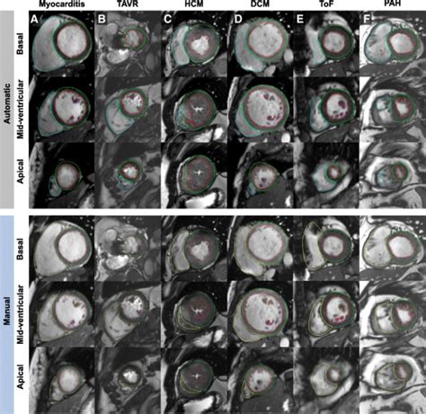 Fully Automated Quantification Of Biventricular Volumes And Function In