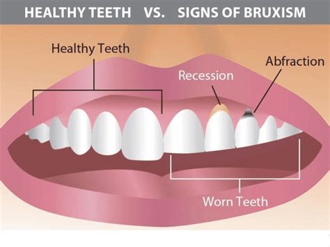 Tooth Abfraction Treatment