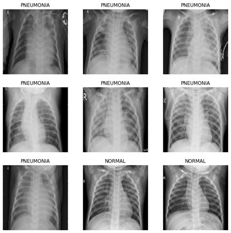 Github Inuwamobarakchest Xray Pneumonia Detection Pneumonia