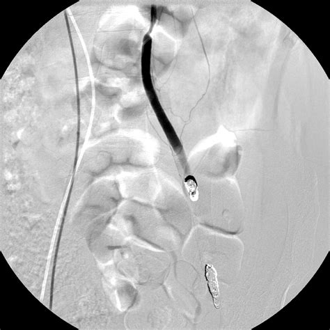 Venous Embolization Case Albany Ir