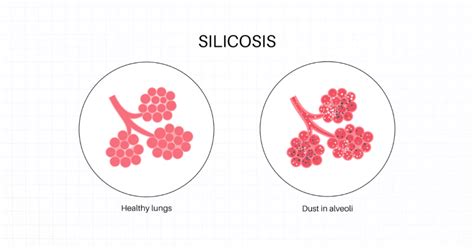 Silicosis: Causes, Symptoms, Diagnosis, and Treatment (2024)