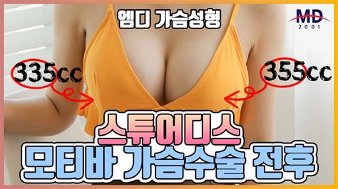 가슴확대 후기 C컵이 되기를 원하신 스튜어디스의 모티바 가슴수술 전후 비교 Youtube