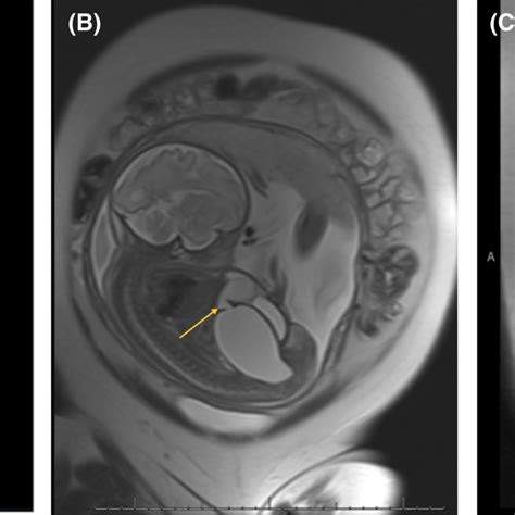 Hypoinflated lungs. This is another common finding of infants born with ...