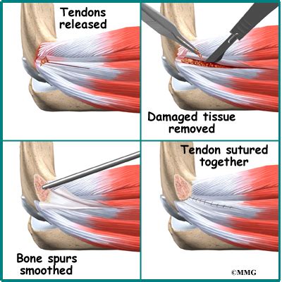 Lateral Epicondylitis (Tennis Elbow) - Orthopedic Surgery, Algonquin ...