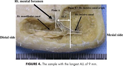 Incisive Canal Mandible