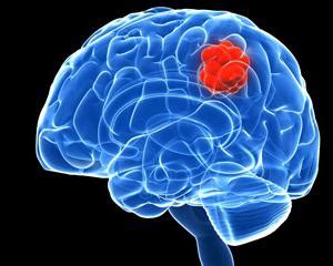 Rak Mozga Znakovi I Simptomi Prvi Znakovi Raka Mozga
