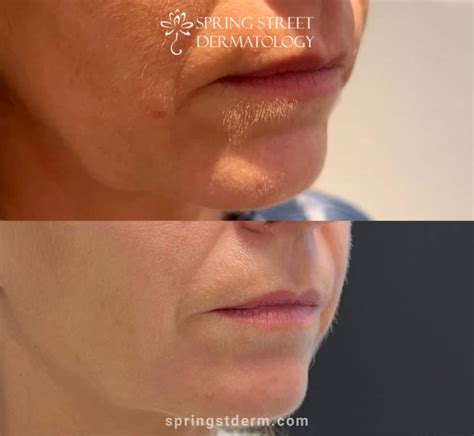 Agnes Rf Microneedling Treatment In Soho And Uptown New York