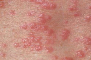 What Is Scabies Symptoms Causes Diagnosis Treatment And Prevention