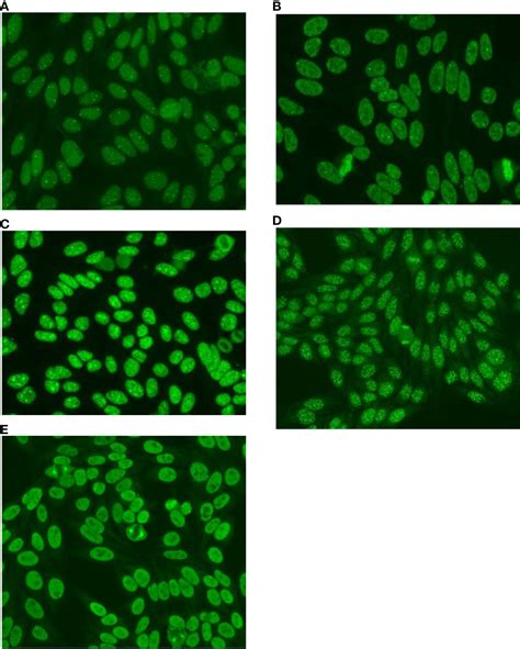 Frontiers Complex Patterns On Hep 2 Indirect Immunofluorescence Assay In A Large Sample