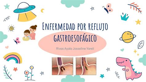 Enfermedad Por Reflujo Gastroesofagico Michelle Hernandez Udocz