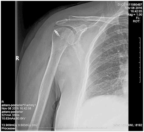 Aaos Arthroscopic Biceps Tenotomy