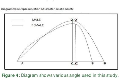 Figure 1 From Determination Of Sex From Greater Sciatic Notch Of Hip Bone A Cross Sectional