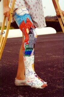 GIMPIX Showcasing The Artistry Of The Plaster Of Paris Leg Cast From