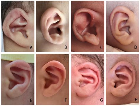 Ear Molding For Congenital Auricular Deformities Efficacy And Factors