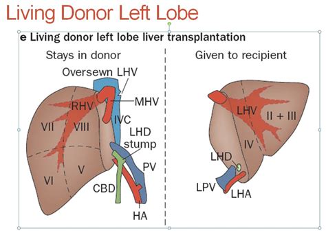 Liver Living Donor UW MEDICINE ULTRASOUND