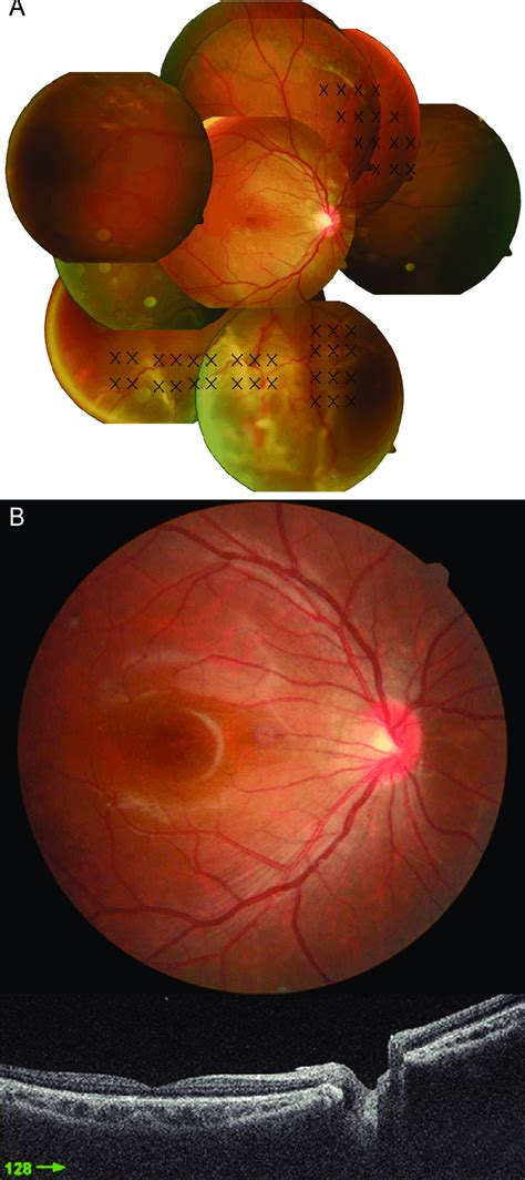 Rhegmatogenous Retinal Detachment