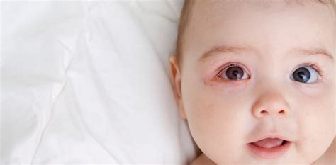 Conjunctivitis in Babies - Treatment and Symptoms Of Conjunctivitis ...