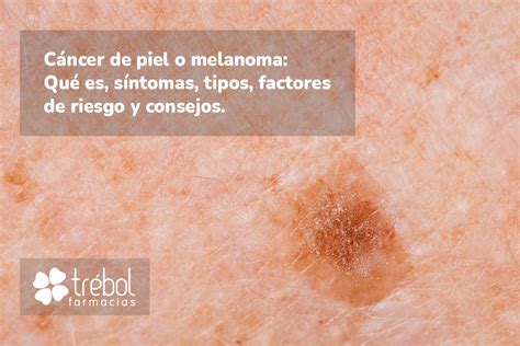 C Ncer De Piel O Melanoma Qu Es S Ntomas Tipos Factores De Riesgo