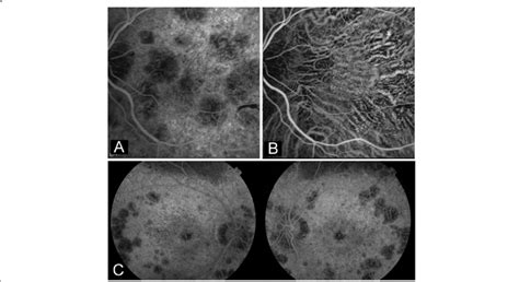 Fundus Fluorescein Angiography Ffa And Indocyanine Green Icg