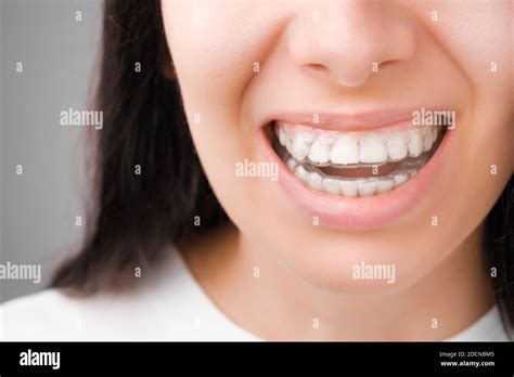 What Does A Perfect Dental Bite Look Like At Cornelia Priest Blog