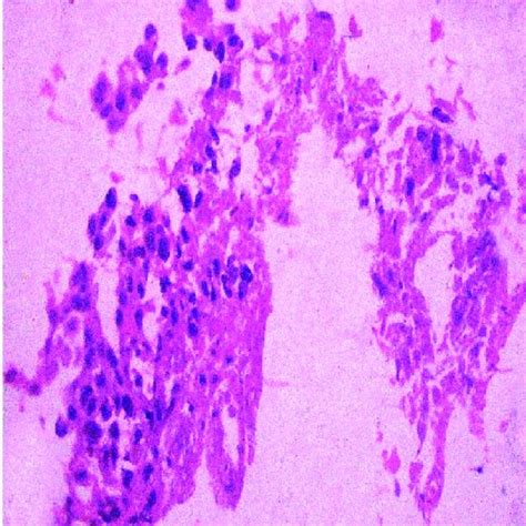 Final Histopathological Diagnosis Of Biopsy Download Scientific Diagram