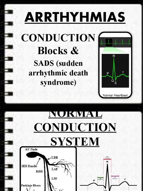 Arrthyhmias Conduction Blocks And Download Free Pdf Electrocardiography Internal Medicine