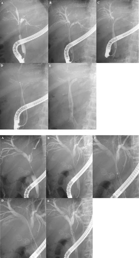 Hilar Biliary Stent