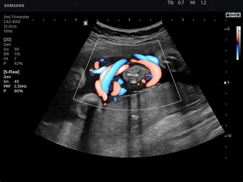 Hypercoiled Umbilical Cord Ultrasound