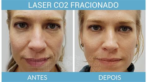 Valores Tratamento De Laser De Co2 Fracionado Clínica De Pele Dr