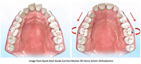 Carriere® Motion Appliance Does It Work Orthodontics In Summary