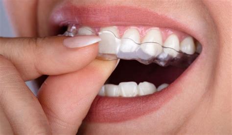 7 Things You Should Know Before Getting Invisalign 7 Must Know Tips