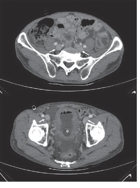 Figure 2 From An Unusual Case Of Bilateral Peripheral Edema In A Male