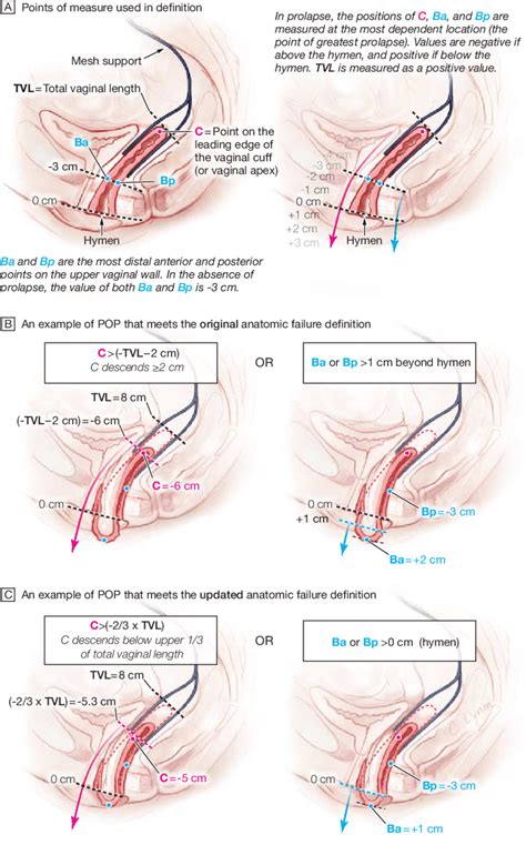 How To Fix A Prolapse Without Surgery Maybe You Would Like To Learn