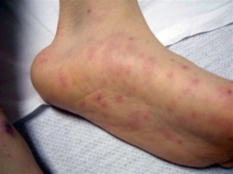 Meningococcal Disease Causes Symptoms And Treatment