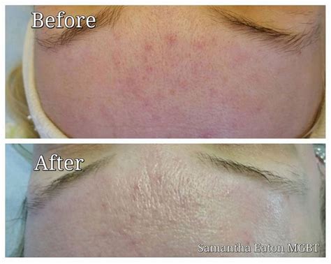 Before And After Pictures Of Microdermabrasion Client Treated For