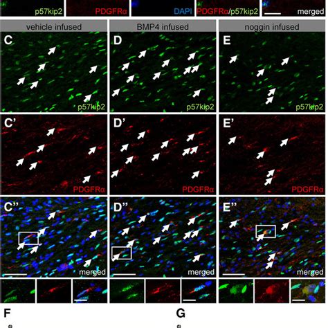 Subcellular localization of p57kip2 in the CC of healthy and diseased ... 