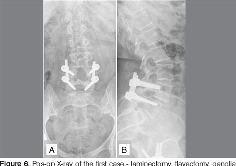 Figure 1 From Clinical Acute Presentation Of Lumbar Facet Joint Ganglia