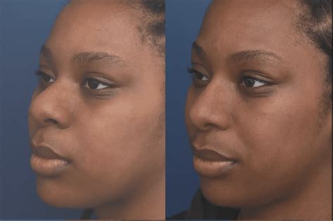 What Is Ethnic Rhinoplasty Blog Ronald Schuster Plastic Surgery