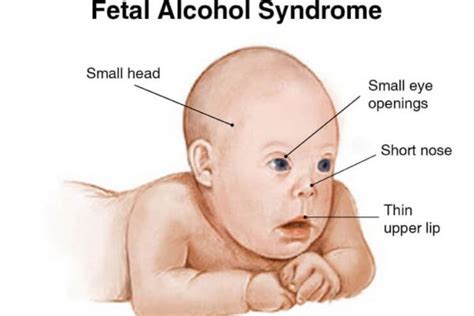 Fetal Alcohol Syndrome Chart