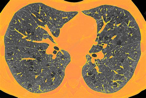 Emphysema Lung Disease Axial Ct Scan Stock Image C