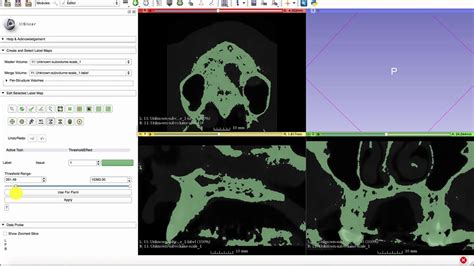 How To Make A 3D STL Bone Model From CBCT DICOM Using 3D Slicer For