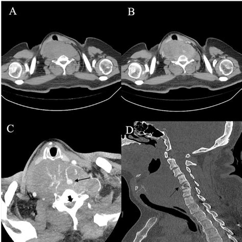 Axial A Axial Contrast Enhanced Ct Image B Mip Of Cta C And